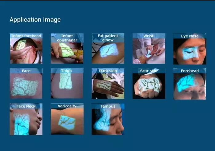 vein finder4.jpg
